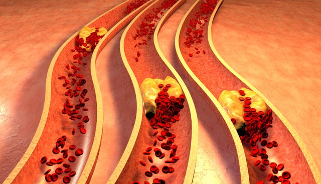 <p>Diagram of a clogged artery with platelets and cholesterol plaque</p>