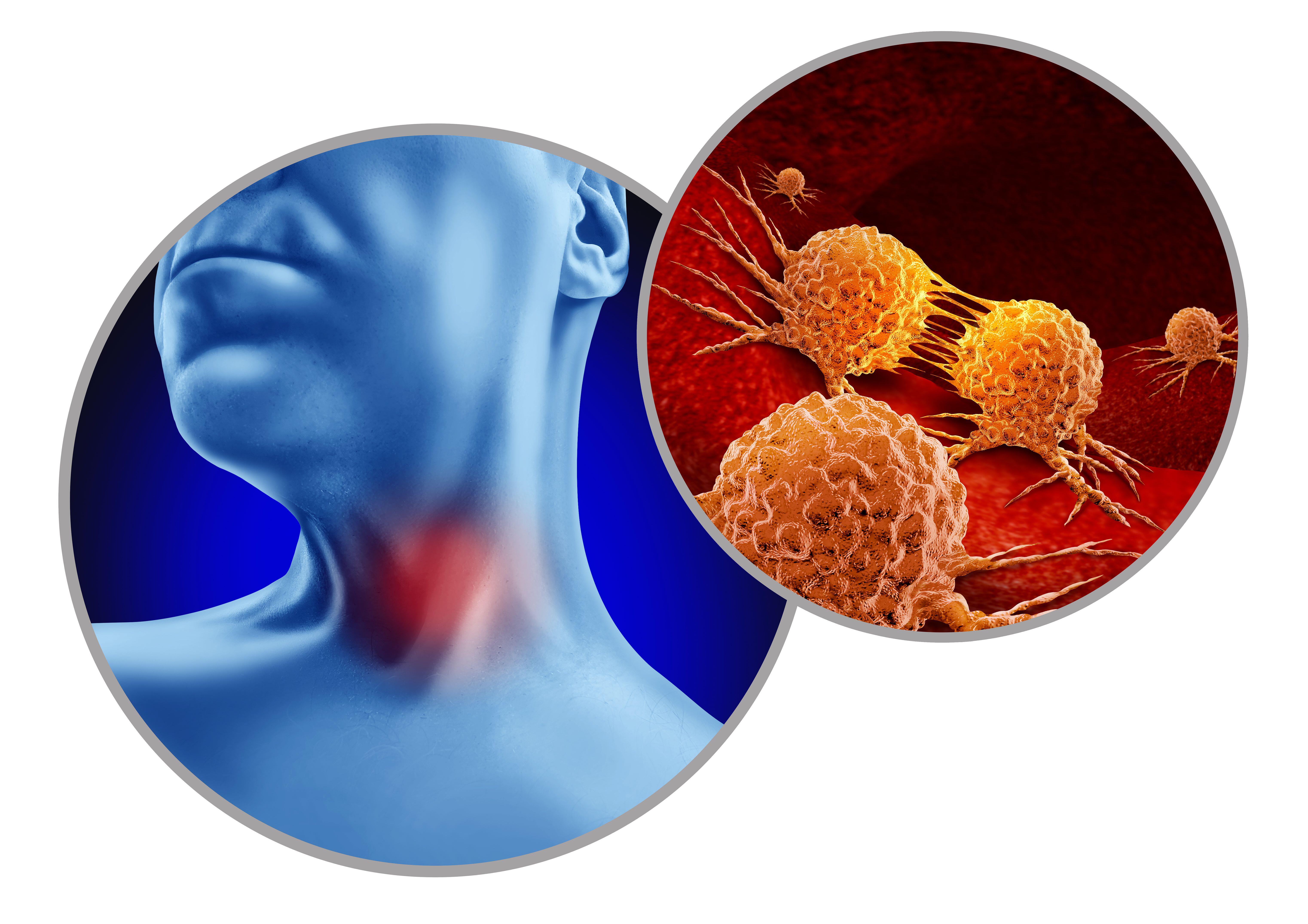 Illustration of cancer in a neck (Alamy/PA)