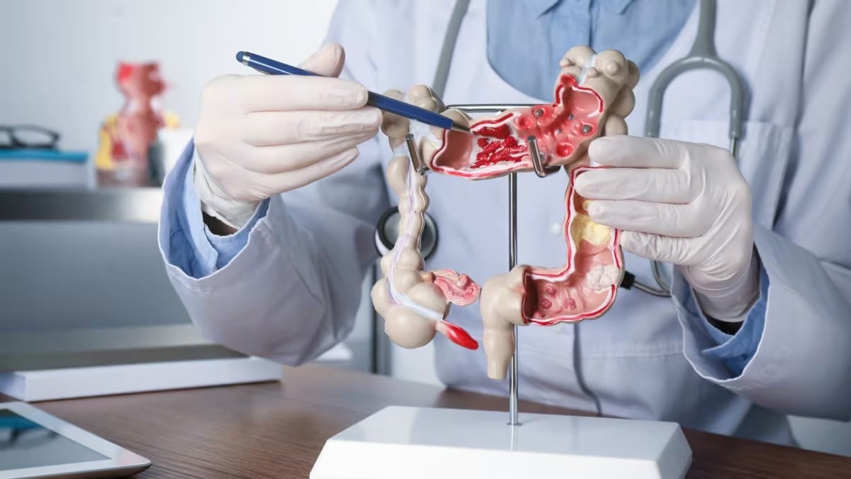 A doctor points at a model of the human colon. Colorectal cancer, also known as colon cancer, is a disease in which cells in a person’s colon or rectum grow out of control. Getting screened is important to preventing colorectal cancer, and health experts hope to deploy better messaging to entice those who avoid the topic.