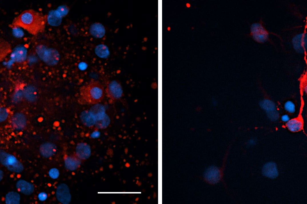 Disintegrating neurons can be seen on the left hand panel and healthier neurons on the right (University of Aberdeen/PA)