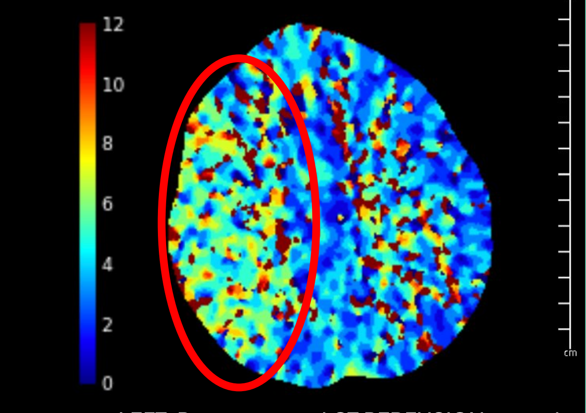 An artery in Sean Clifford’s brain was a stroke waiting to happen, but a Prenuvo radiologist told him everything looked normal, according to a new lawsuit