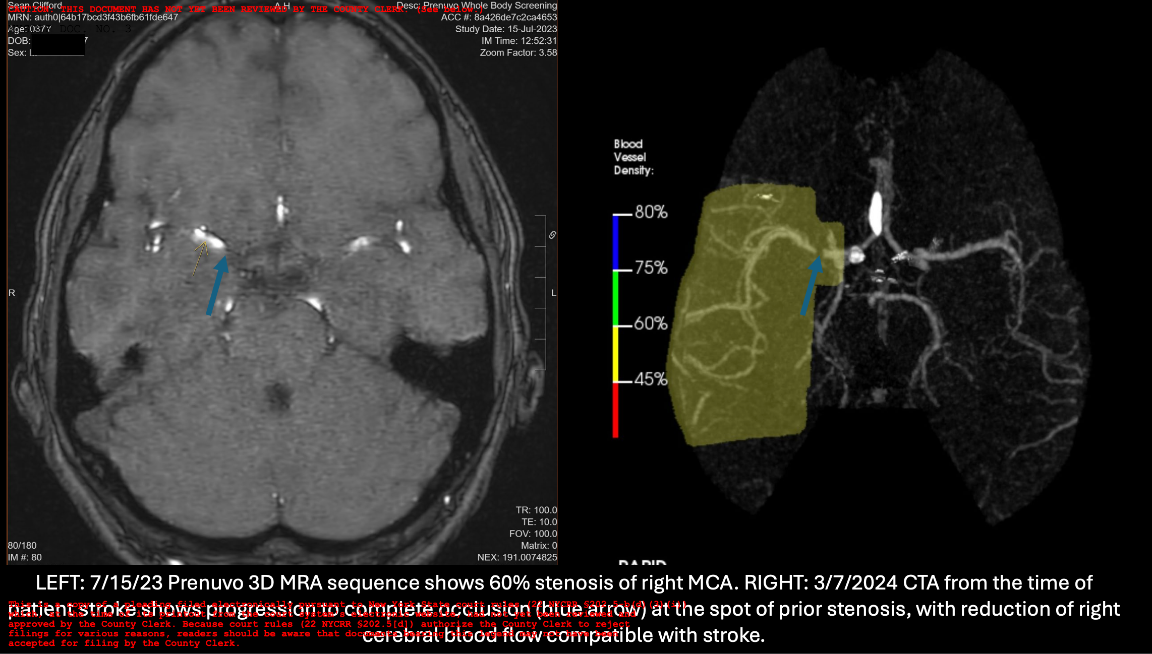 Sean Clifford’s MRI scans showed clear warning signs of an impending stroke, which he says a Prenuvo radiologist negligently missed