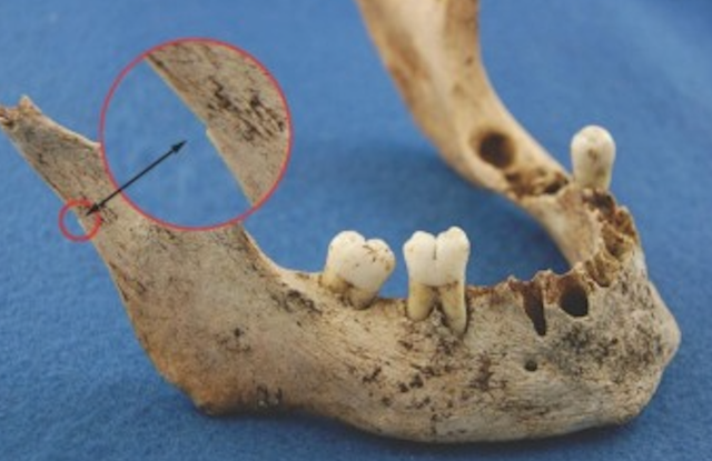 <p>Jawbone showing modification consistent with cannibalism</p>