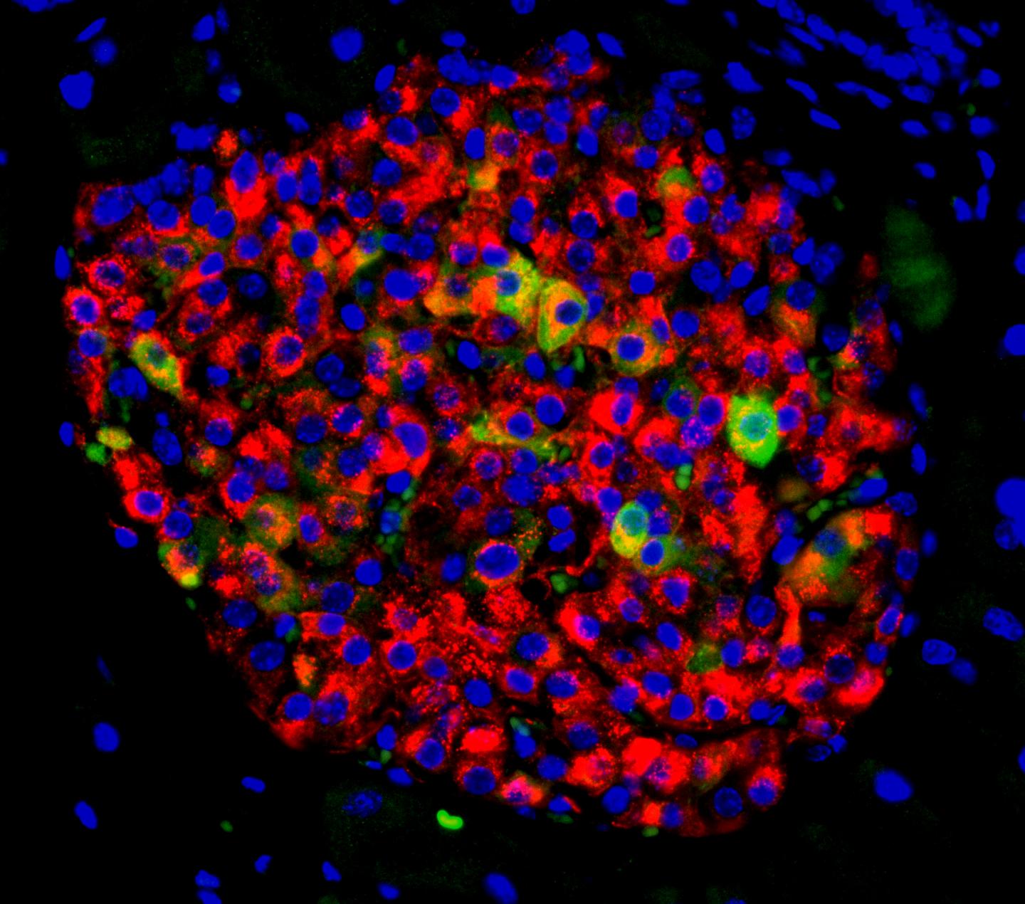 Pancreatic islet with insulin-producing beta cells (in red) and beta cells showing signs of nonaccomplishment  (in yellowish  and green)