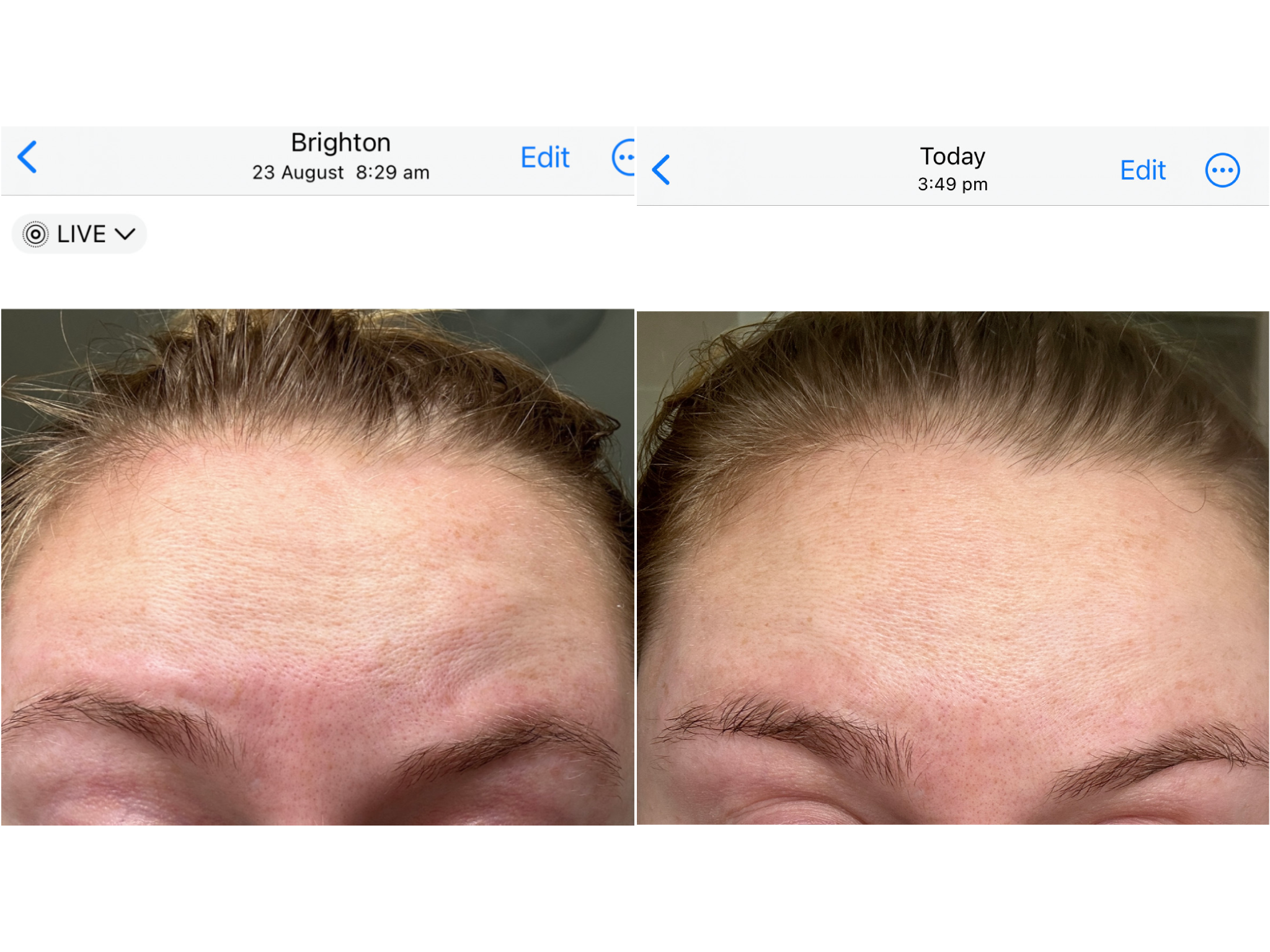 The state of the fine lines on my forehead with eyebrows raised one week into testing (left) and the same fine lines with eyebrows raised five weeks later on 30 September (right)