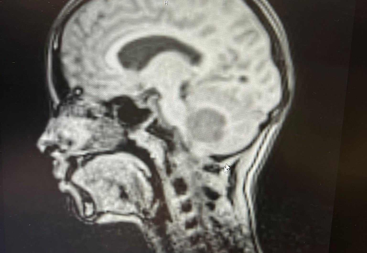 Amelie’s brain tumour scan