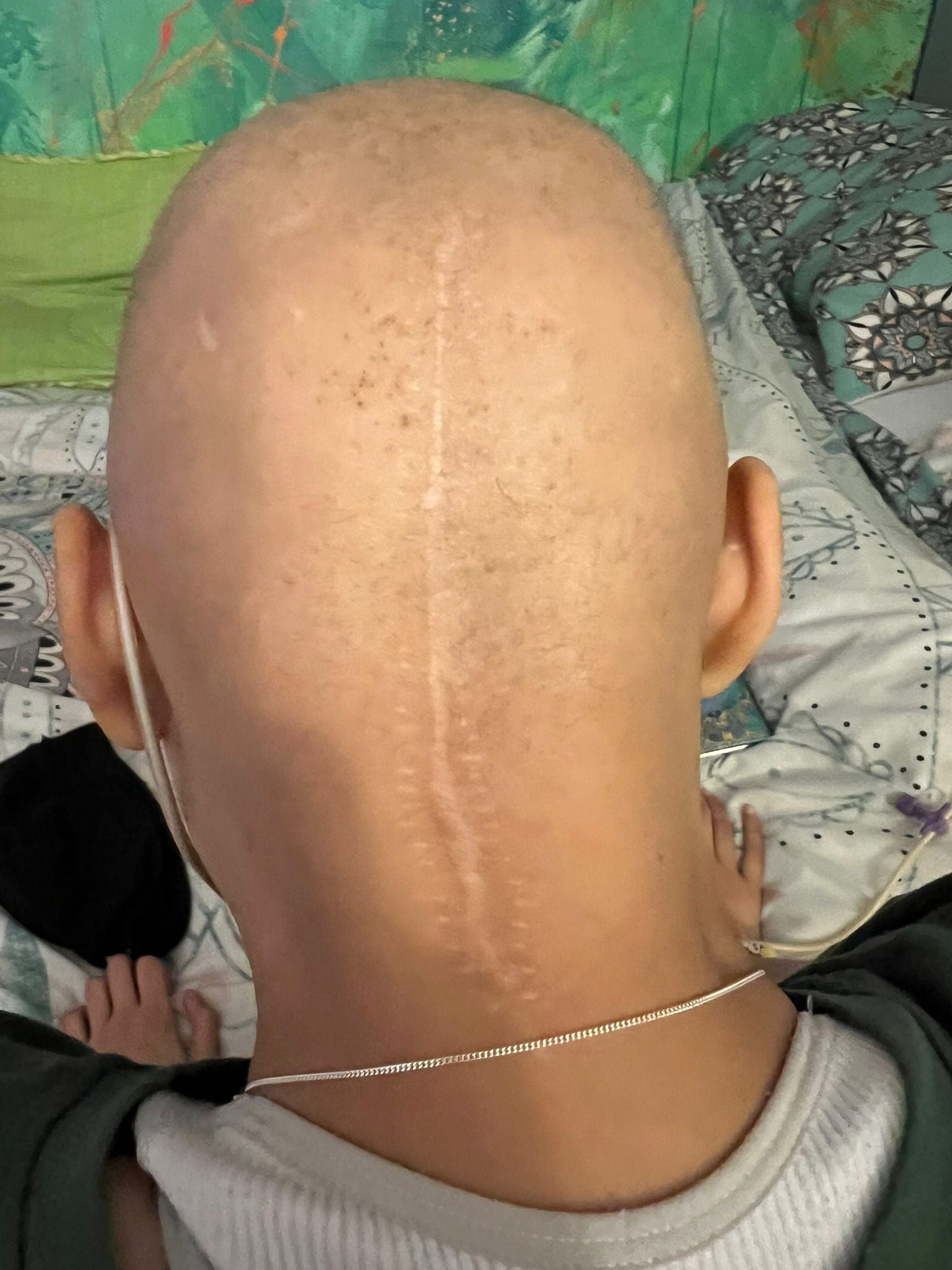 Amelie Williams' scar on the back of her head