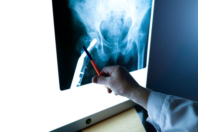 A radiologist examines an X-ray of the hip joint in close-up It is estimated that a third of females and 17% of males over 80 will suffer a hip fracture (Alamy/PA)