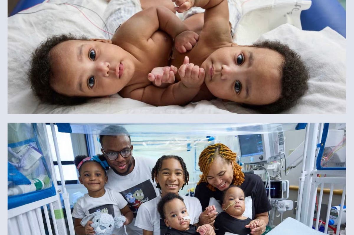 Conjoined twins are successfully separated at Philadelphia hospital, ready to sleep in their own beds Conjoined twins are successfully separated at Philadelphia hospital, ready to sleep in their own beds