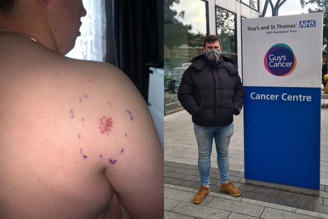 Ben’s lump was initially thought to be ringworm or a tattoo ink allergy (Collect/PA Real Life)