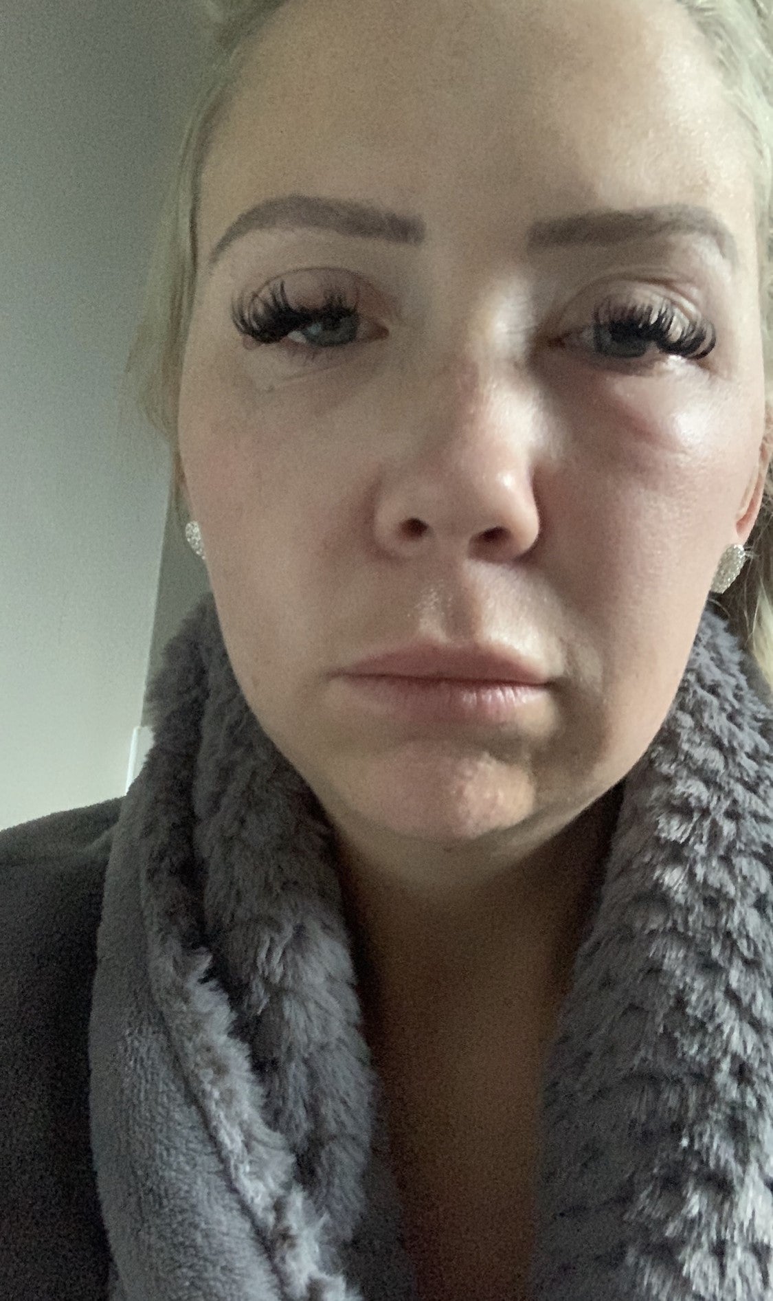 Around two months after having the procedure, Katie’s face swelled up