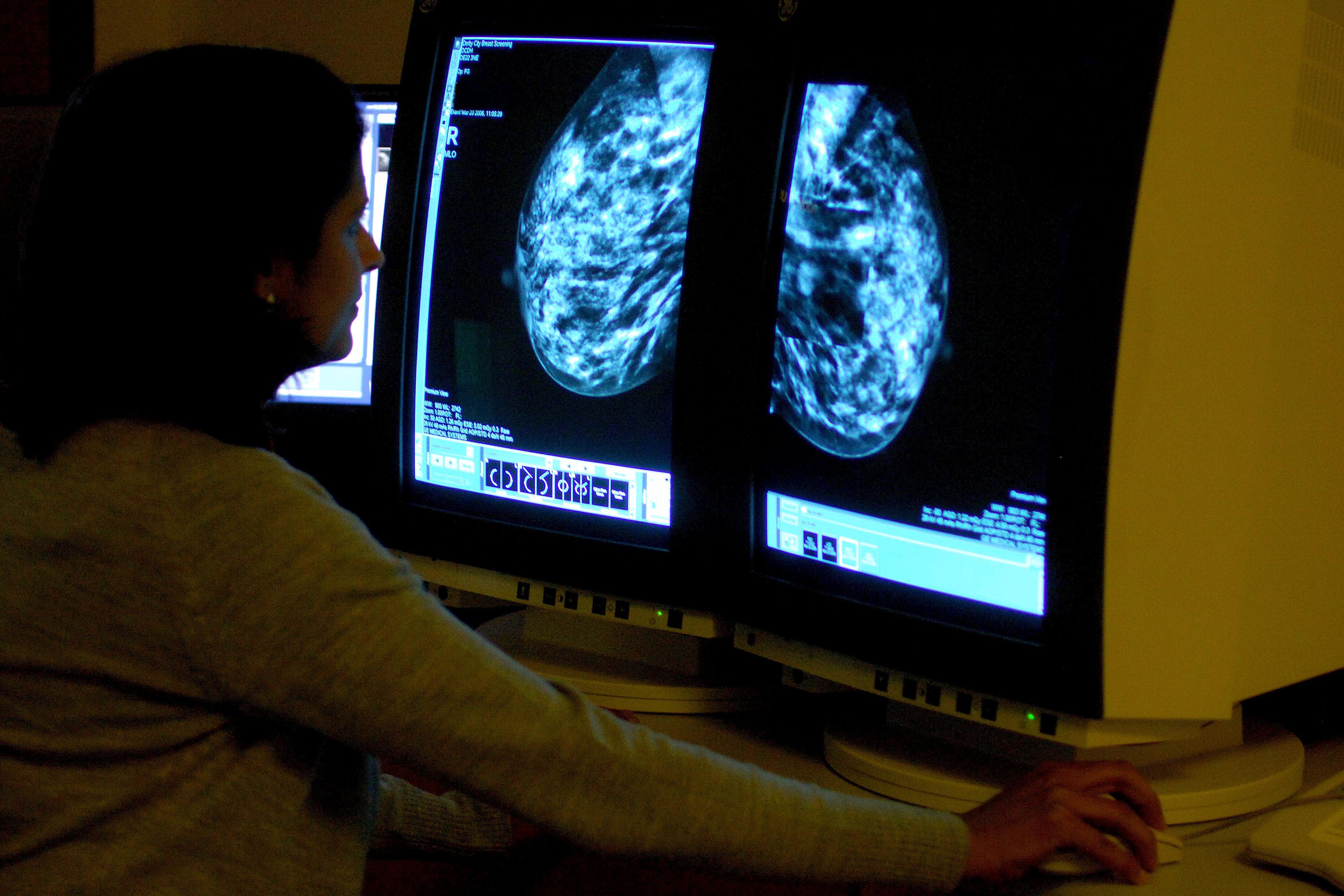 A consultant analysing a mammogram showing a woman’s breast in order check for breast cancer at Derby City Hospital (Rui Vieira/PA)