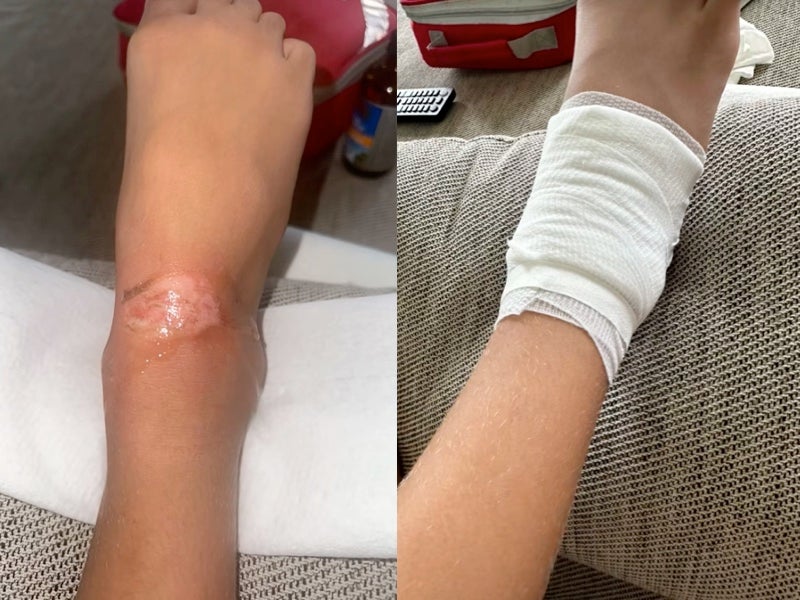 Mother shares how daughter suffered second-degree burns from nail glue incident