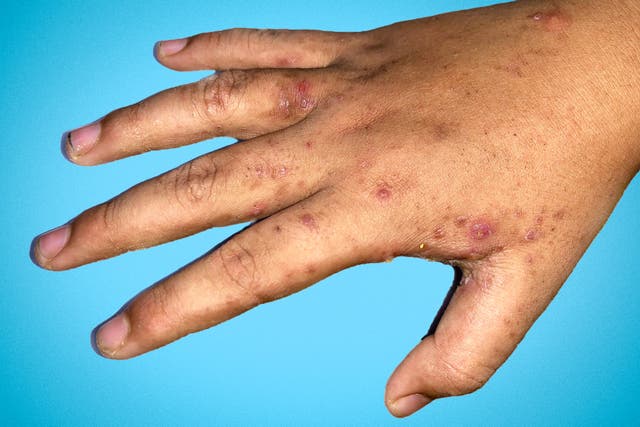 <p>Scabies causes an intensely itchy skin rash caused by mites burrowing under the skin and laying eggs</p>