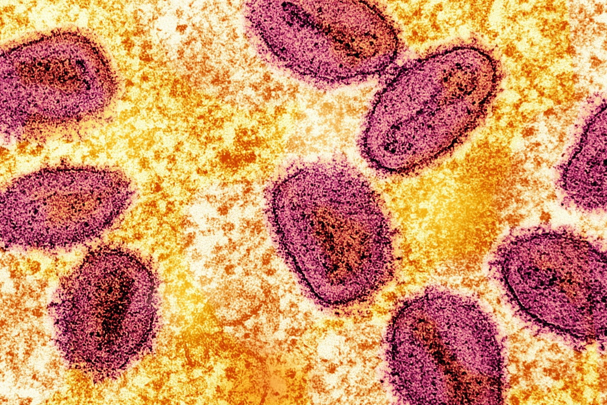 First case of new potentially deadly mpox strain Clade 1b detected in ...