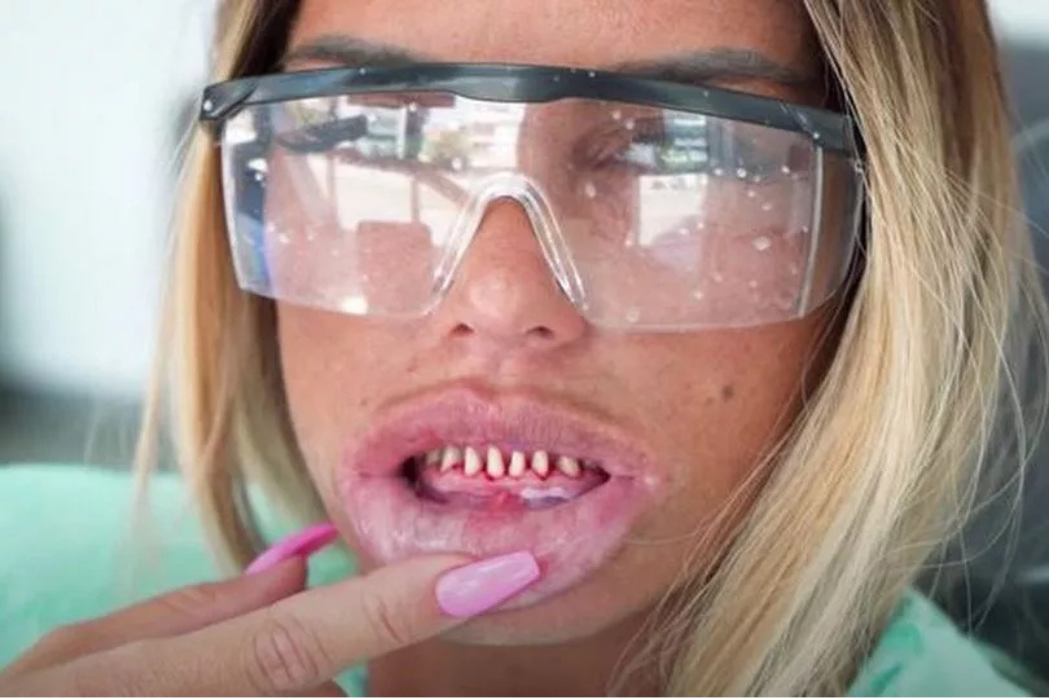 Katie Price after having her teeth filed down to ‘Turkey teeth’ before new dental crowns