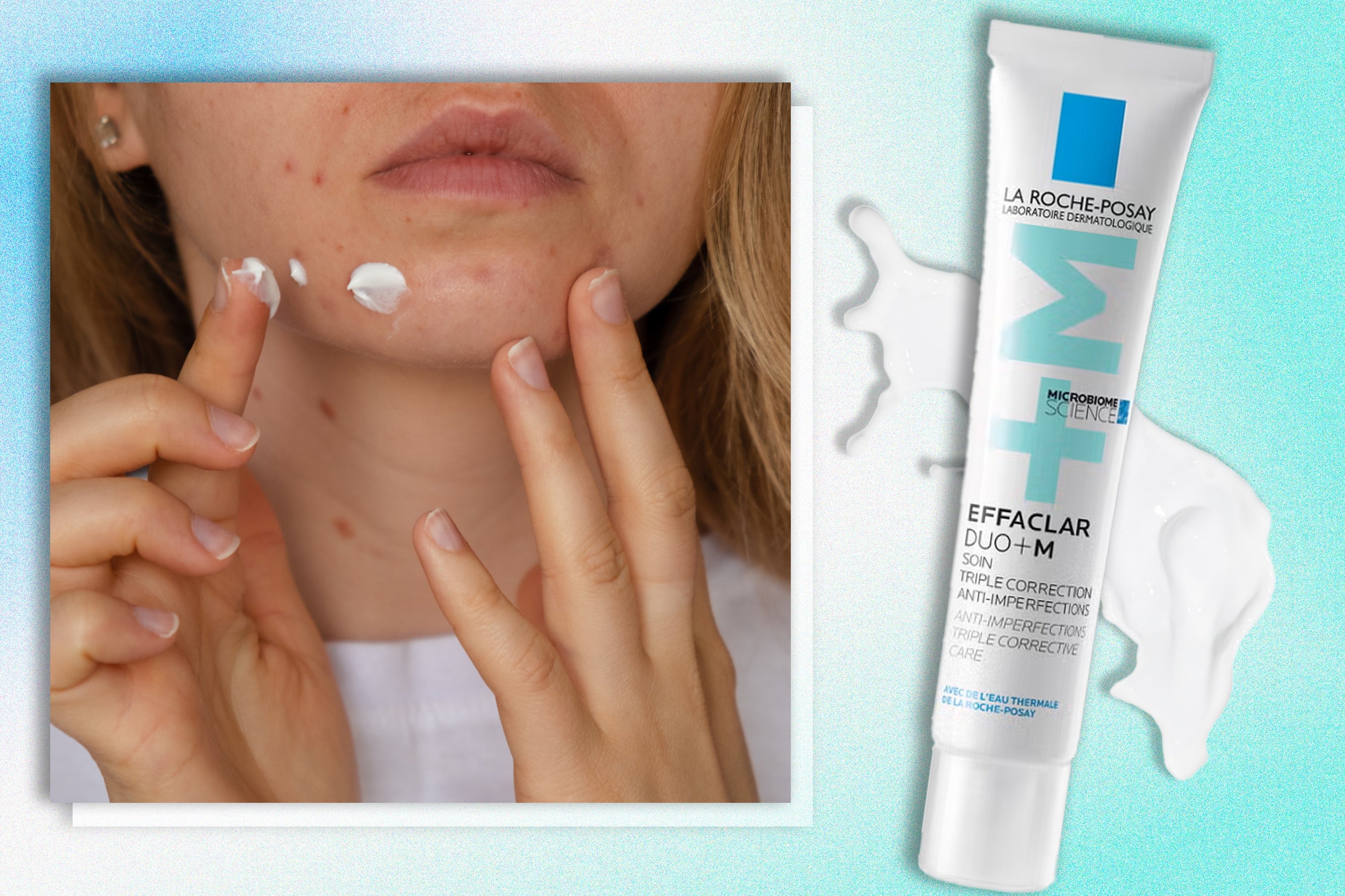 The moisturiser has been chosen as a best buy for acne-prone skin