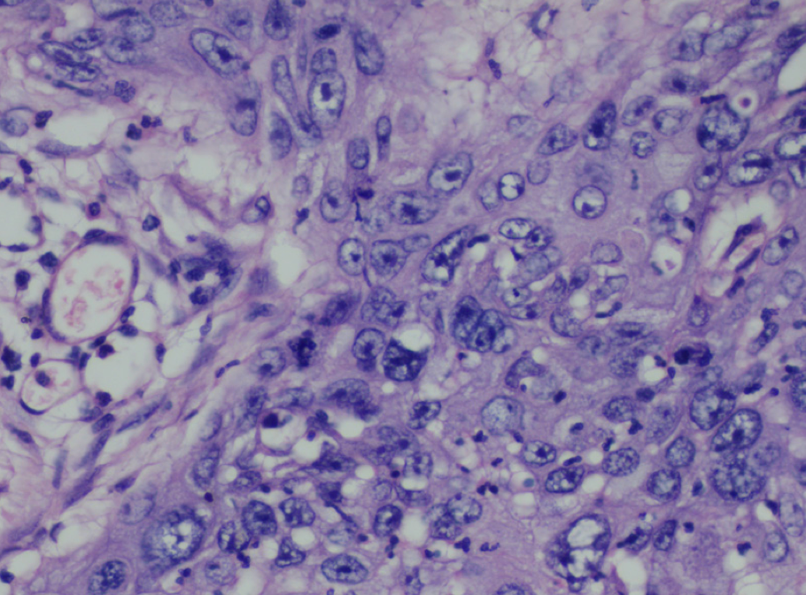 Microscopy section showing signs of skin cancer