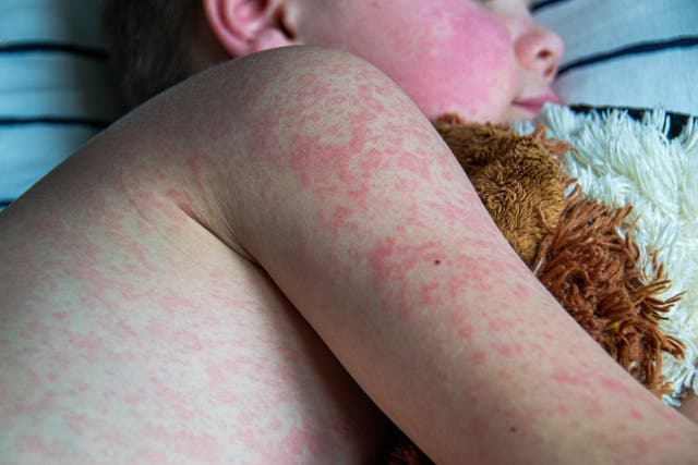 <p>A little boy with measles holds a stuffed animal. Global cases of measles rose by 20 percent from 2022 to 2023, largely due to vaccination gaps in children</p>