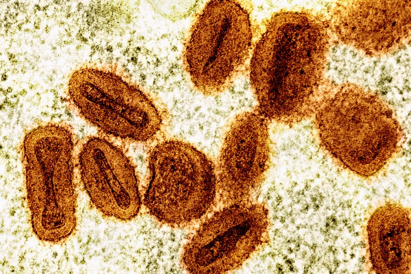 Another case of deadly mpox strain detected in UK