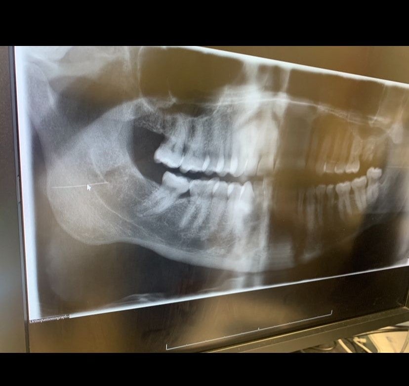 Joe Woollen’s X-ray showing a needle in his mouth