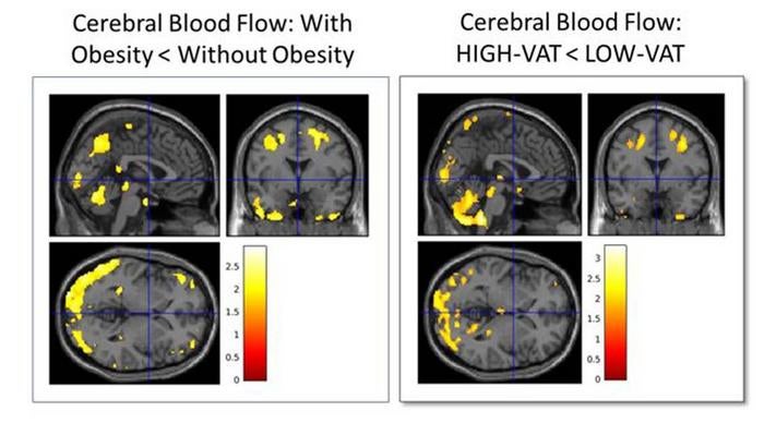 A comparison of blood flow in the brain in 65 cognitively normal middle-aged people showed that individuals with obesity and high visceral fat have reduced blood flow in two of its parts, researchers said Monday. Their research, tying visceral fat to hallmarks of Alzheimer’s disease, was presented on Monday