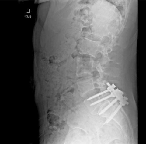 Mangione posted this image on X, showing a spine with pins in it