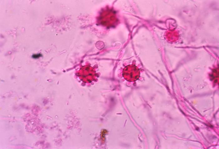 A micrograph image shows the Histoplasma capsulatum fungus. Spores from the fungus can cause histoplasmosis cases