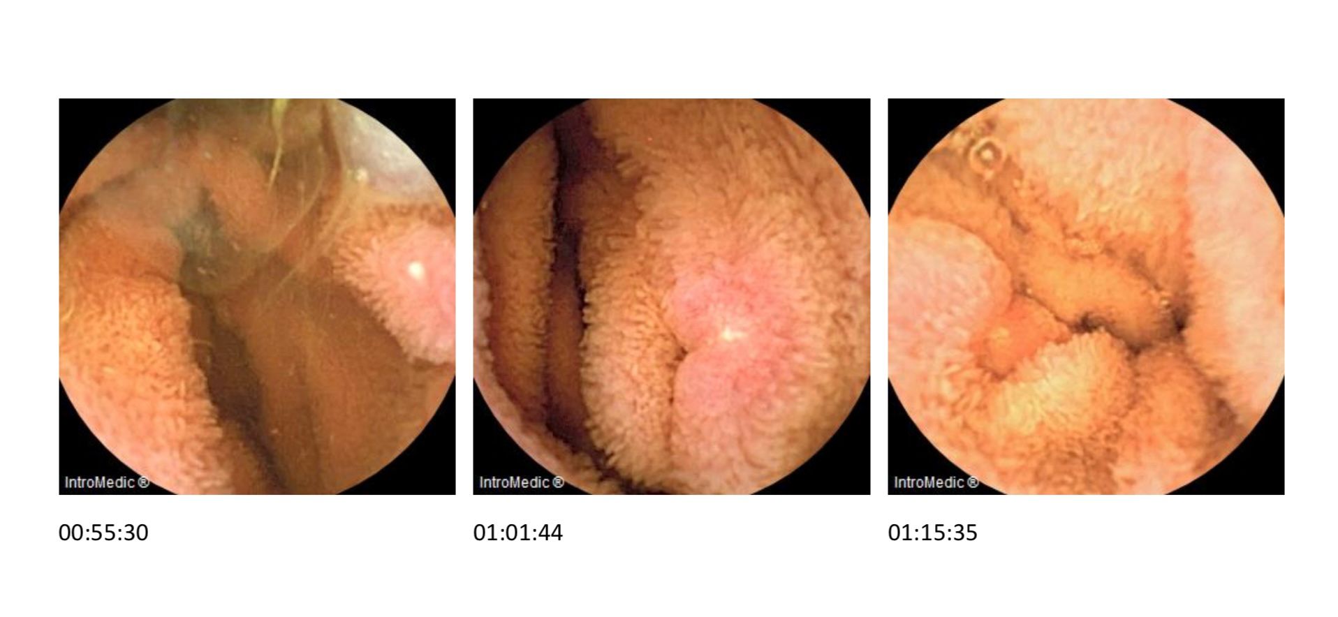 Image showing Kirsten’s inflamed and ulcerated small intestine