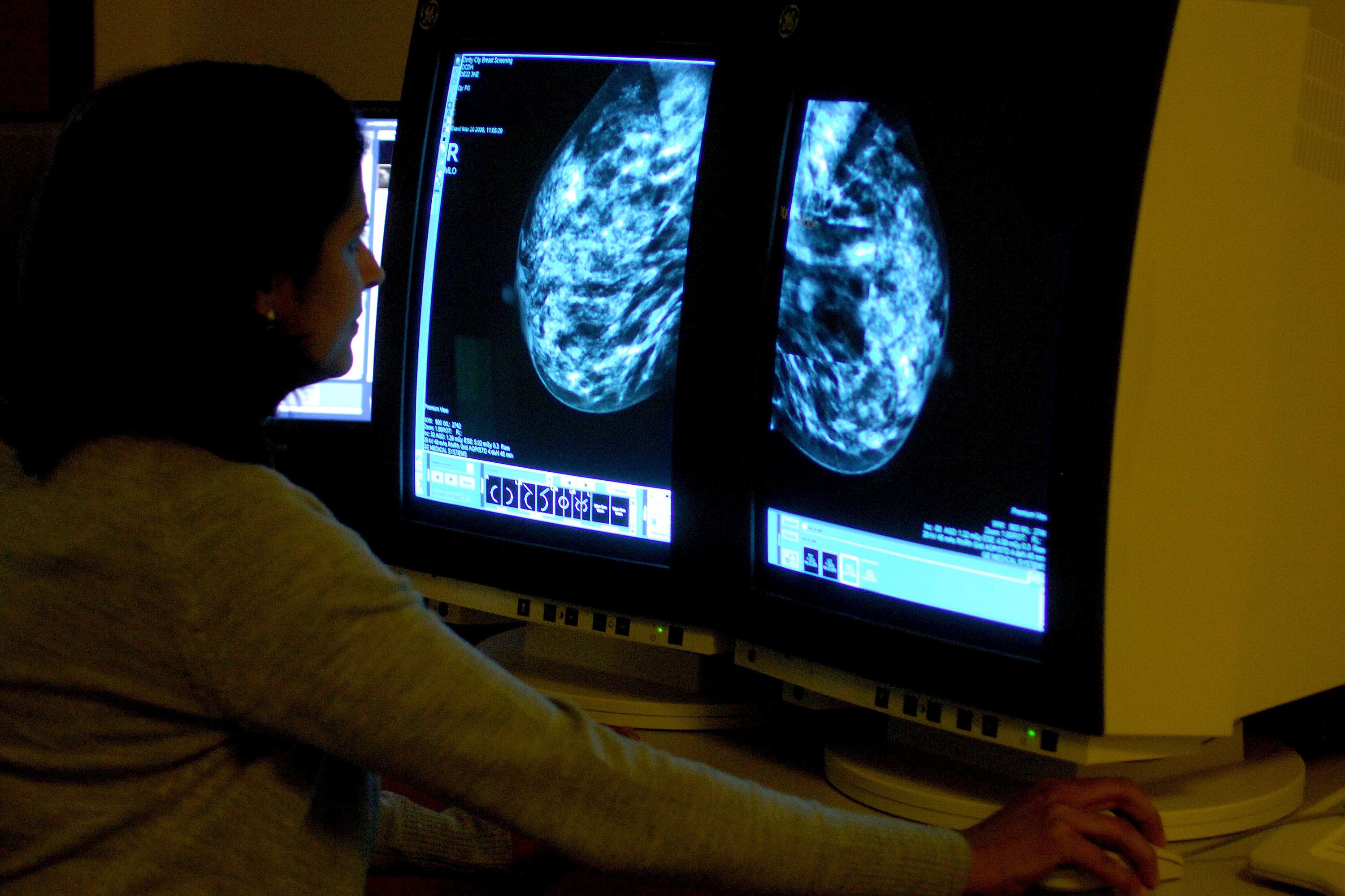 A consultant analysing a mammogram of a woman’s breast (Rui Vieira/PA)