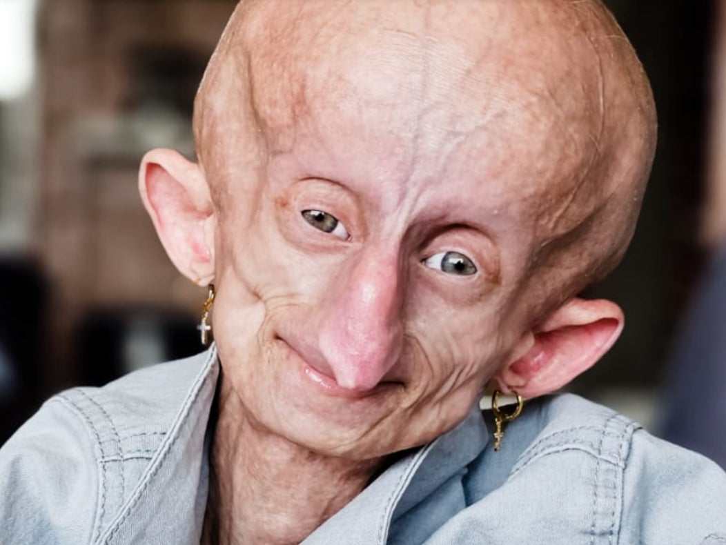 South African TikTok star Beandri Booysen had Progeria, also known as Hutchinson-Gilford progeria syndrome