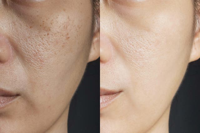 <p>Two pictures compare effect Before and After treatment. skin with problems of freckles , pore , dull skin and wrinkles before and after treatment</p>