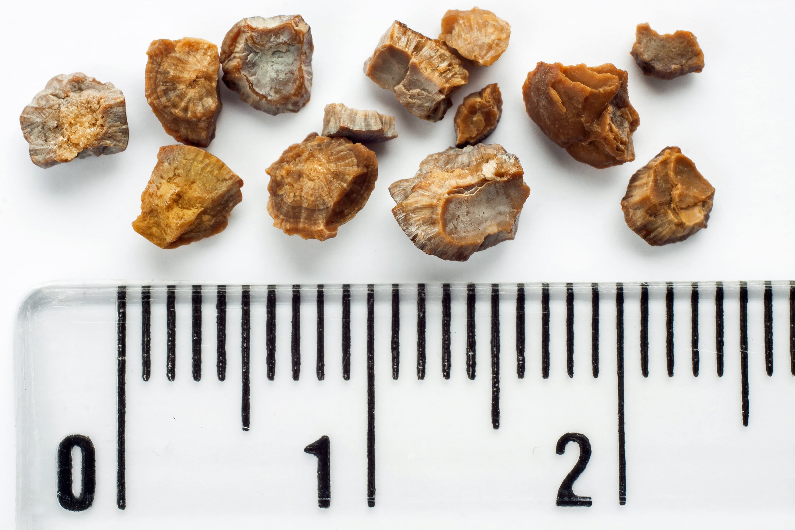 Kidney stones are typically smaller or just larger than a peppercorn and come in various colors. There are multiple factors that contribute to forming the stones, including dehydration