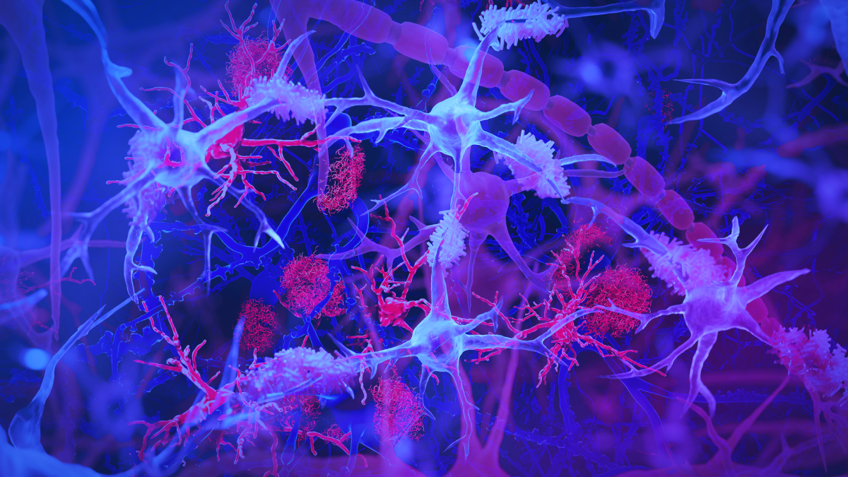 Brain’s immune cells, light blue and purple, shown interacting with amyloid plaques, red, linked to Alzheimer’s disease