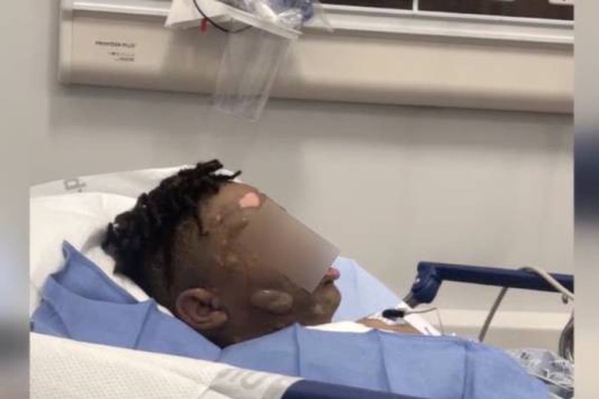 Teenagers Face Charges After Allegedly Burning Boy with Scalding Water