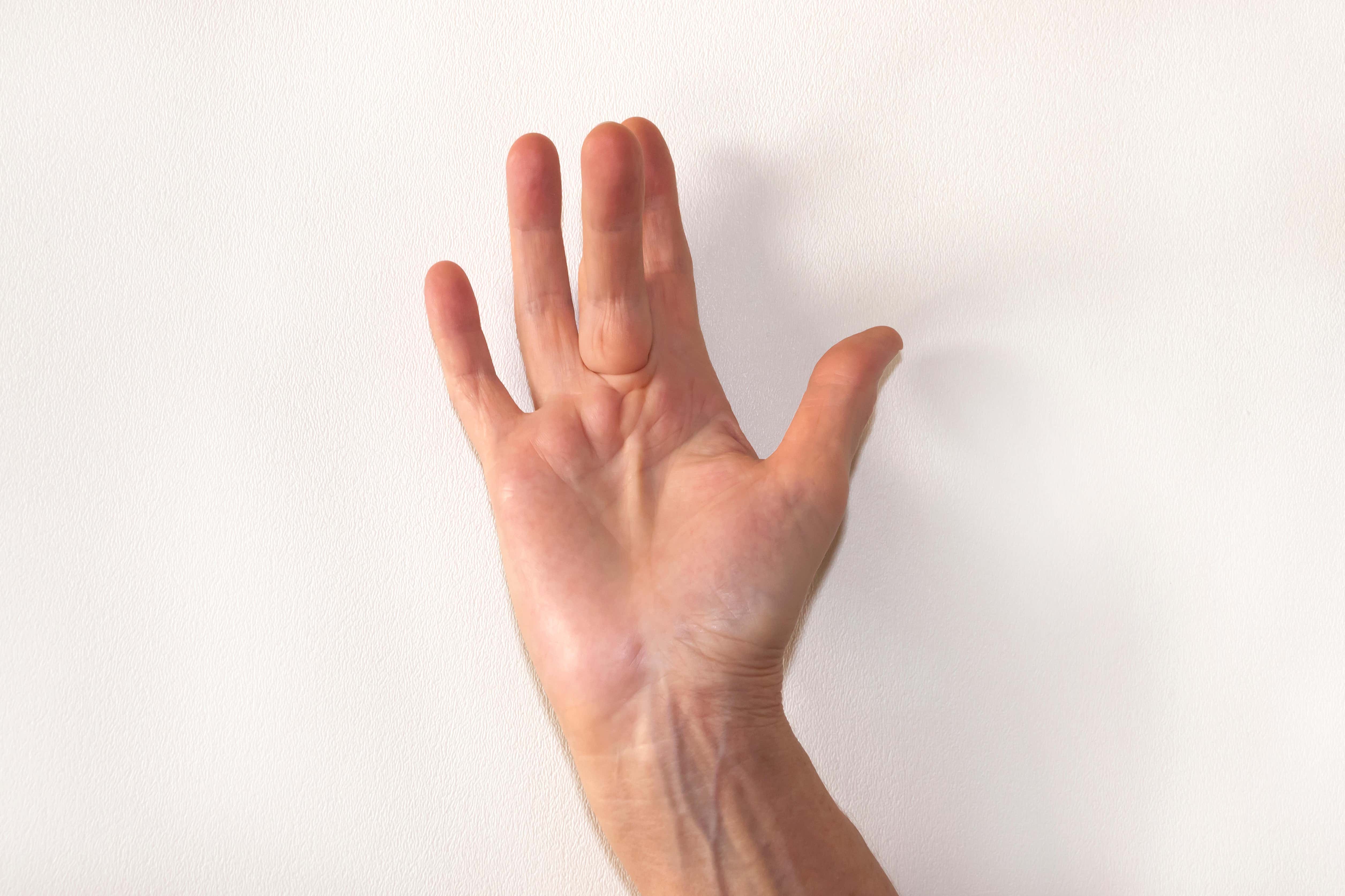 Dupuytren’s contracture happens when the tissue under the skin near your fingers becomes thicker and less flexible, according to the NHS website (Alamy/PA)