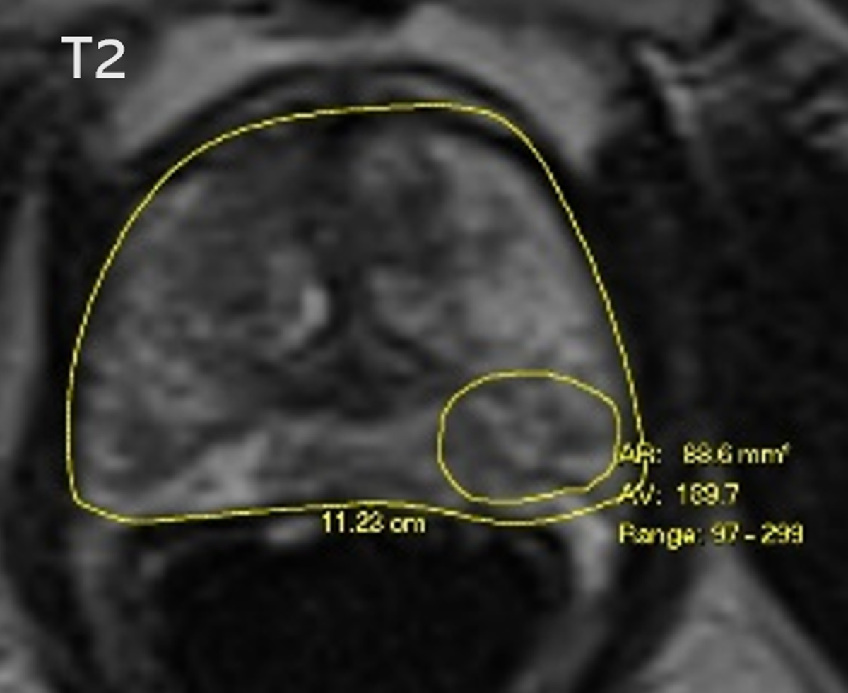 Prostate cancer screening breakthrough could cut time of test to twenty minutes