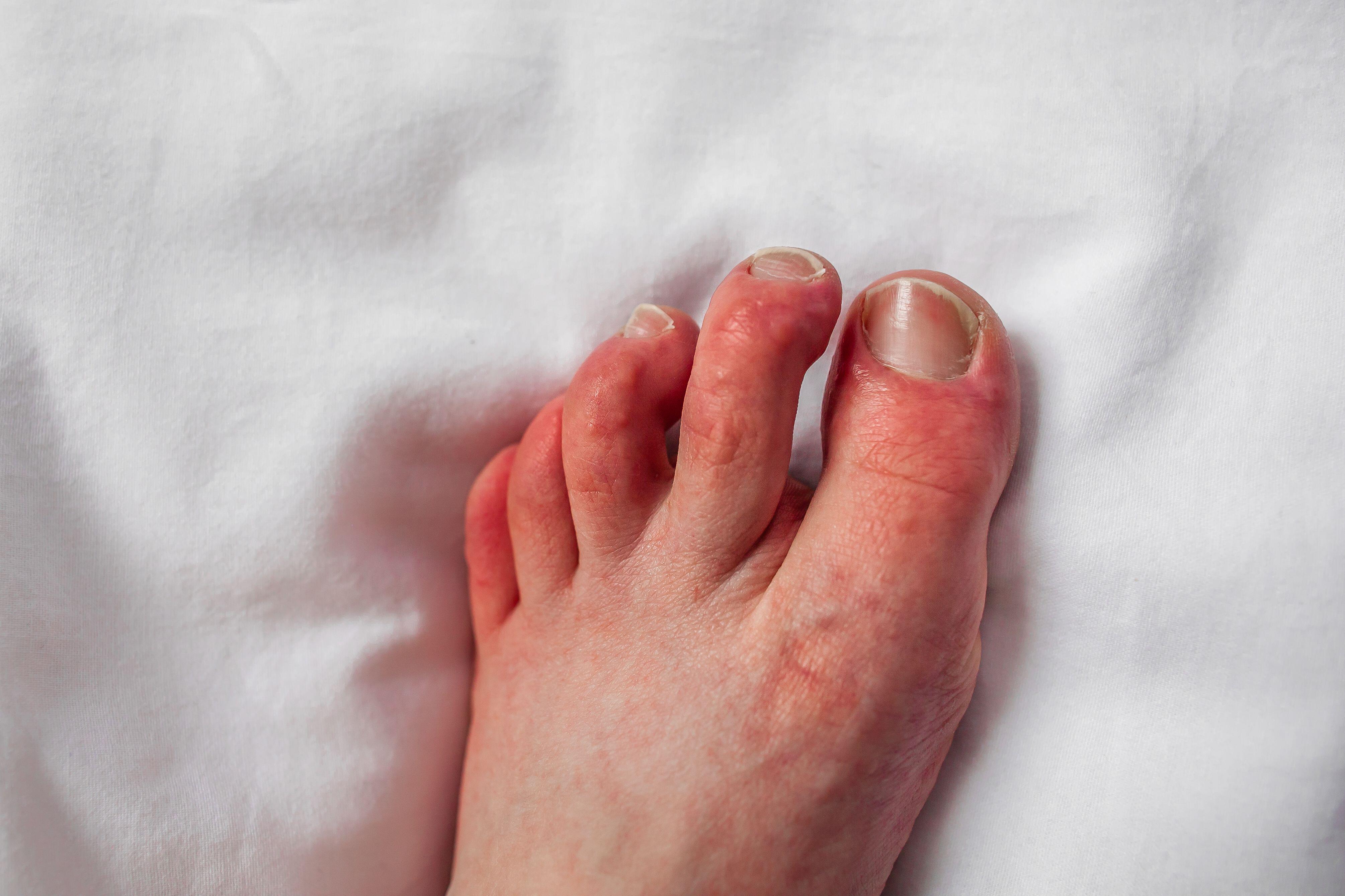 2M04XM0 Chilblains on toes, red itchy bumps, swelling Foot of person with Raynaud’s phenomenon and chilblains lesions Pernio dermatitis on fingers Perniosis