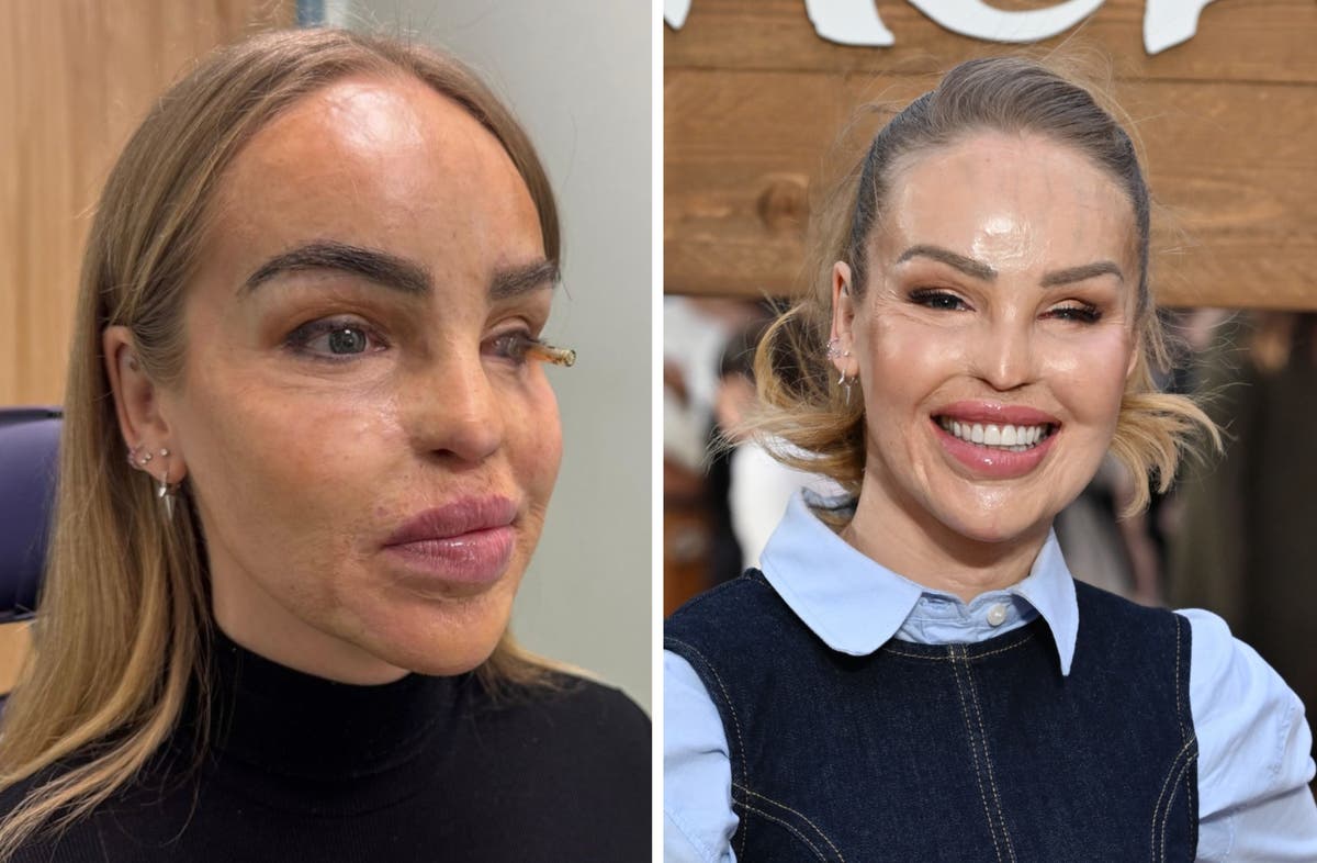 Katie Piper reveals ‘artificial eye’ decision 16 years after acid attack