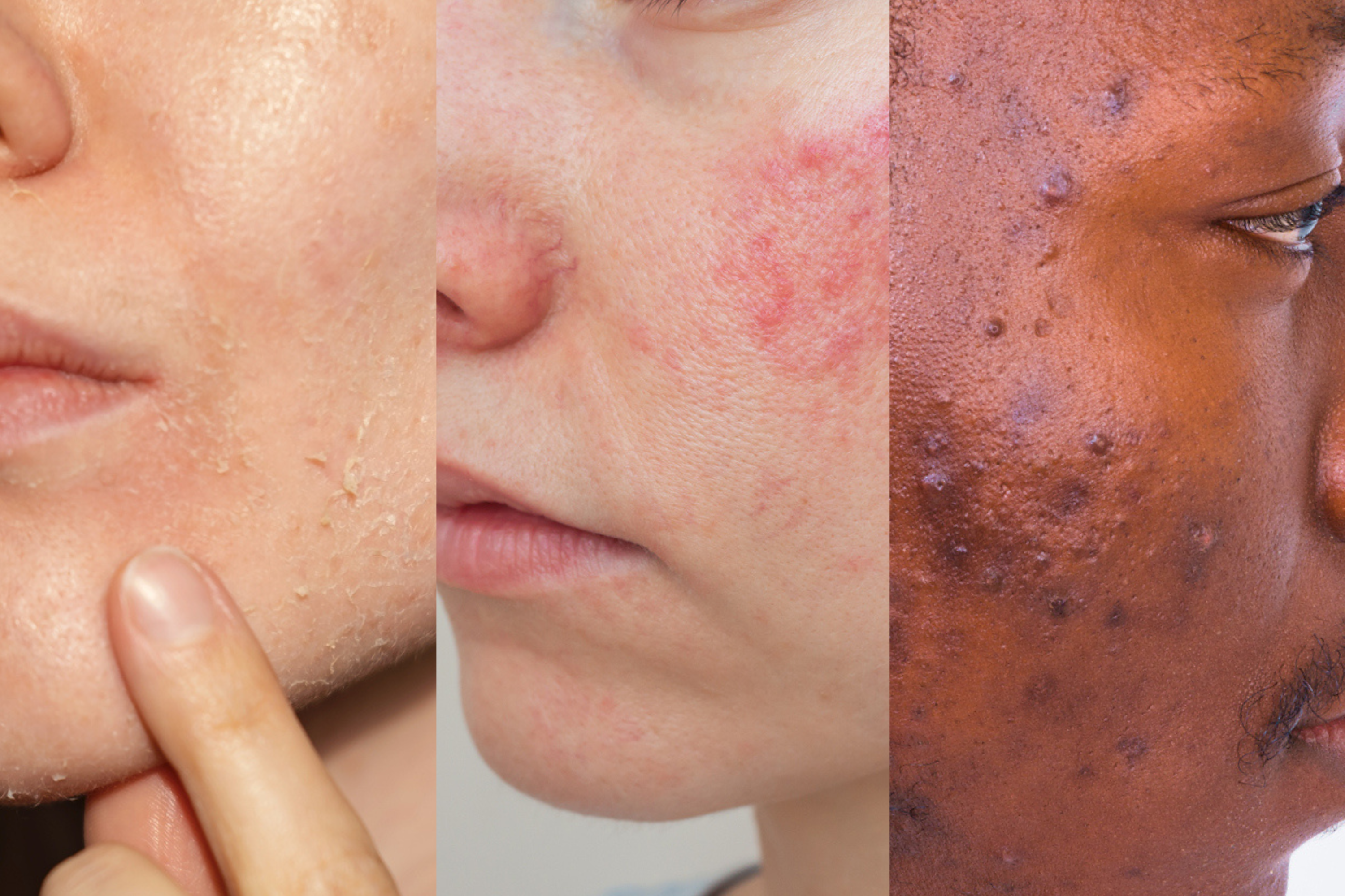 Some examples of how a damaged skin barrier might present symptomatically in different skin types