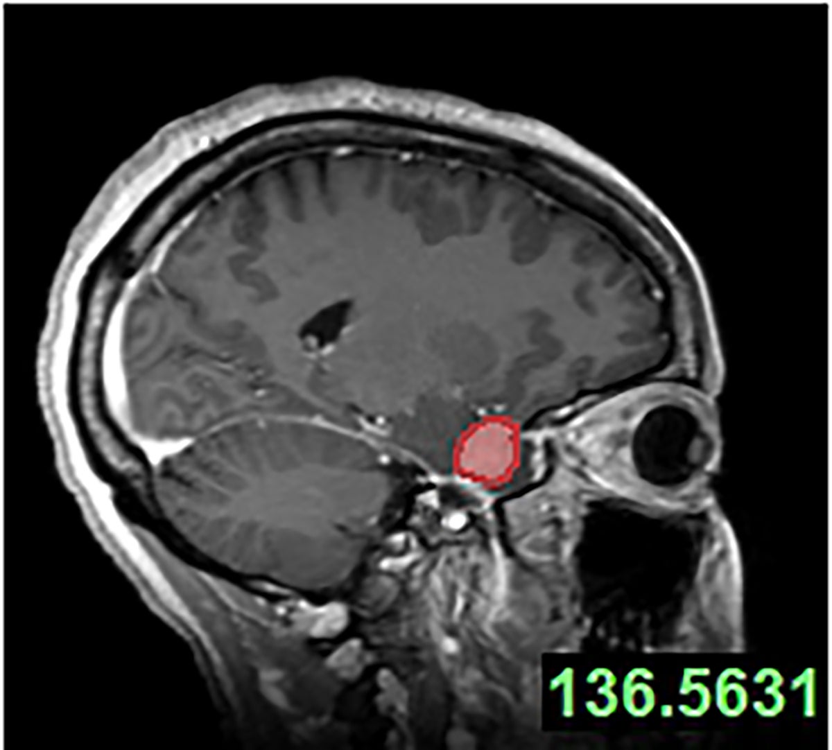 Tumour in woman’s head removed through eye socket in groundbreaking operation