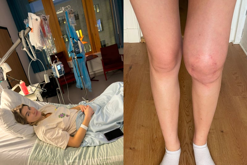 Student dismissed by doctors over sore knee later found to have rare bone cancer