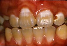 This dental hygiene habit may lower stroke risk, scientists say