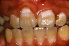 This dental hygiene habit may lower stroke risk, scientists say