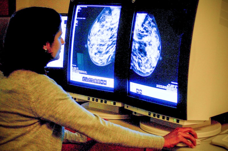 Warning over future increase in breast cancer deaths in the UK