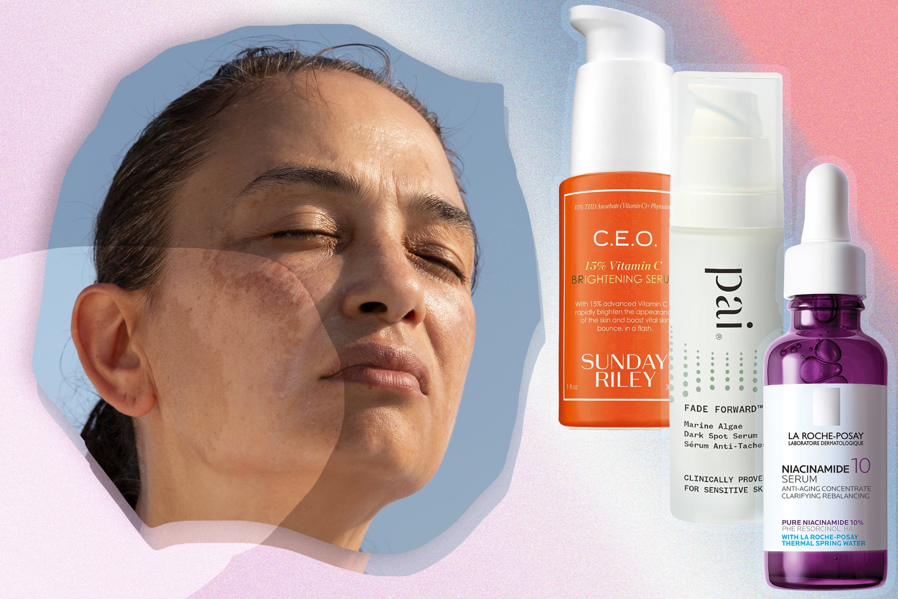 Common types of pigmentation are melasma, post-acne marks and solar lentigines from UV exposure