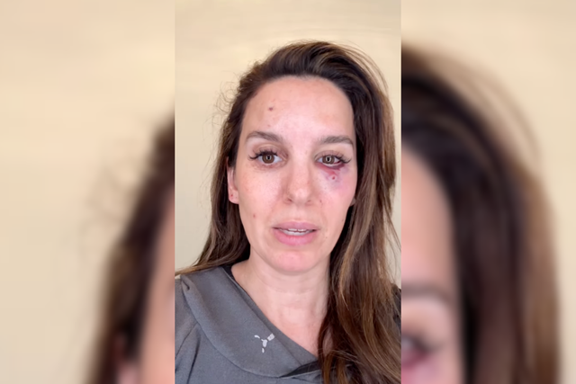 <p>Christy Carlson Romano muestra una herida tras recibir un disparo en la cara</p>