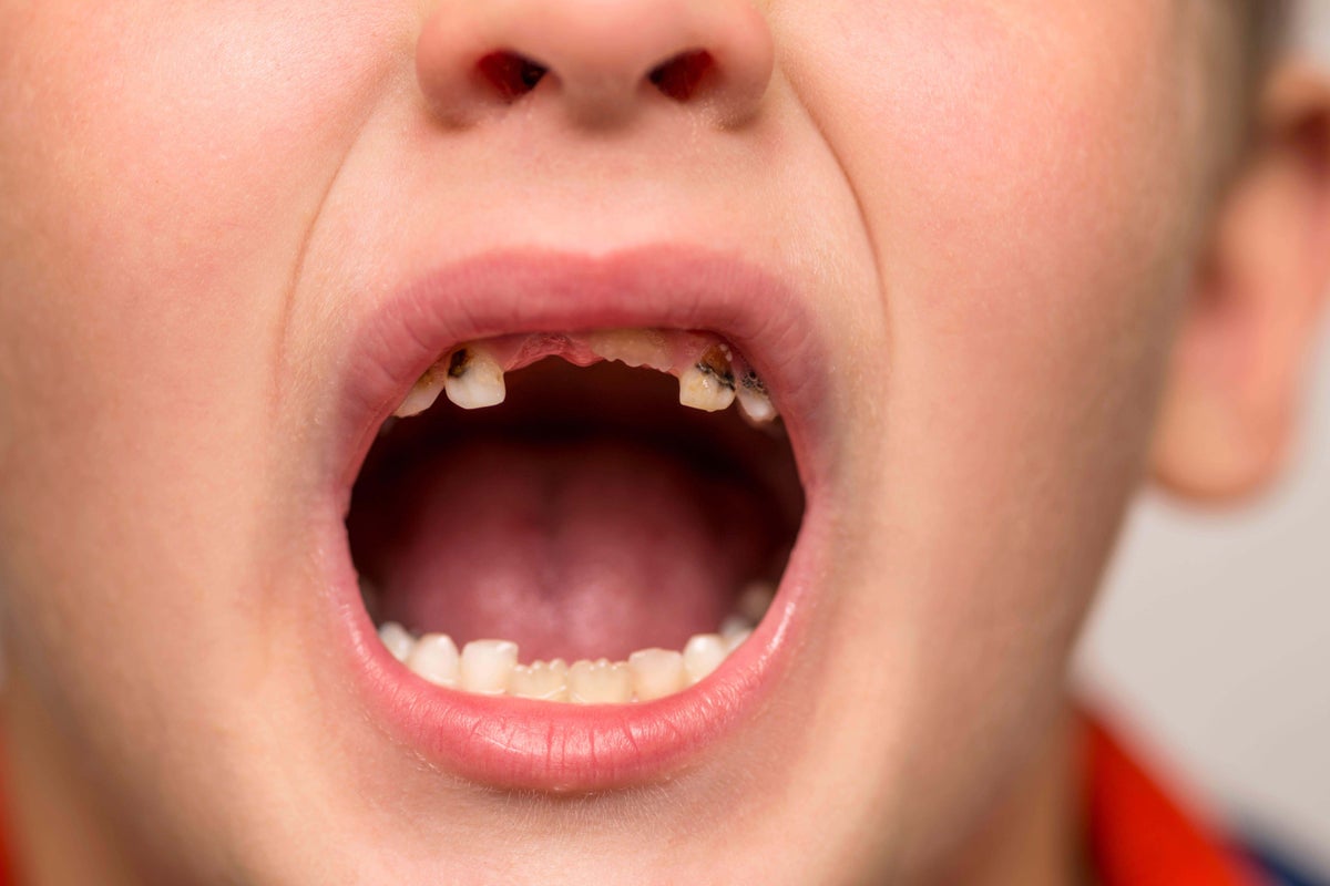 ‘Horrific’ rise in children needing decayed teeth removed ‘Horrific’ rise in children needing decayed teeth removed