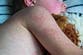 Two children die from measles as highly contagious virus spreads throughout UK