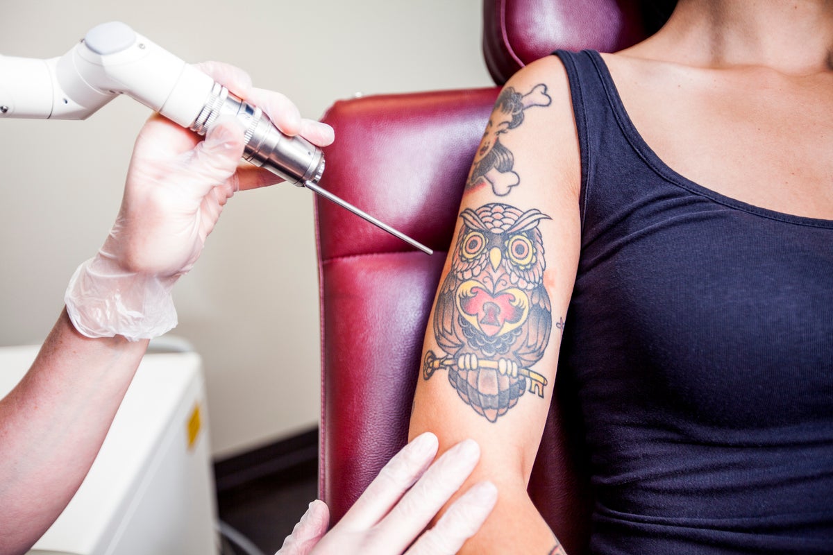What it really feels like to get your tattoos removed